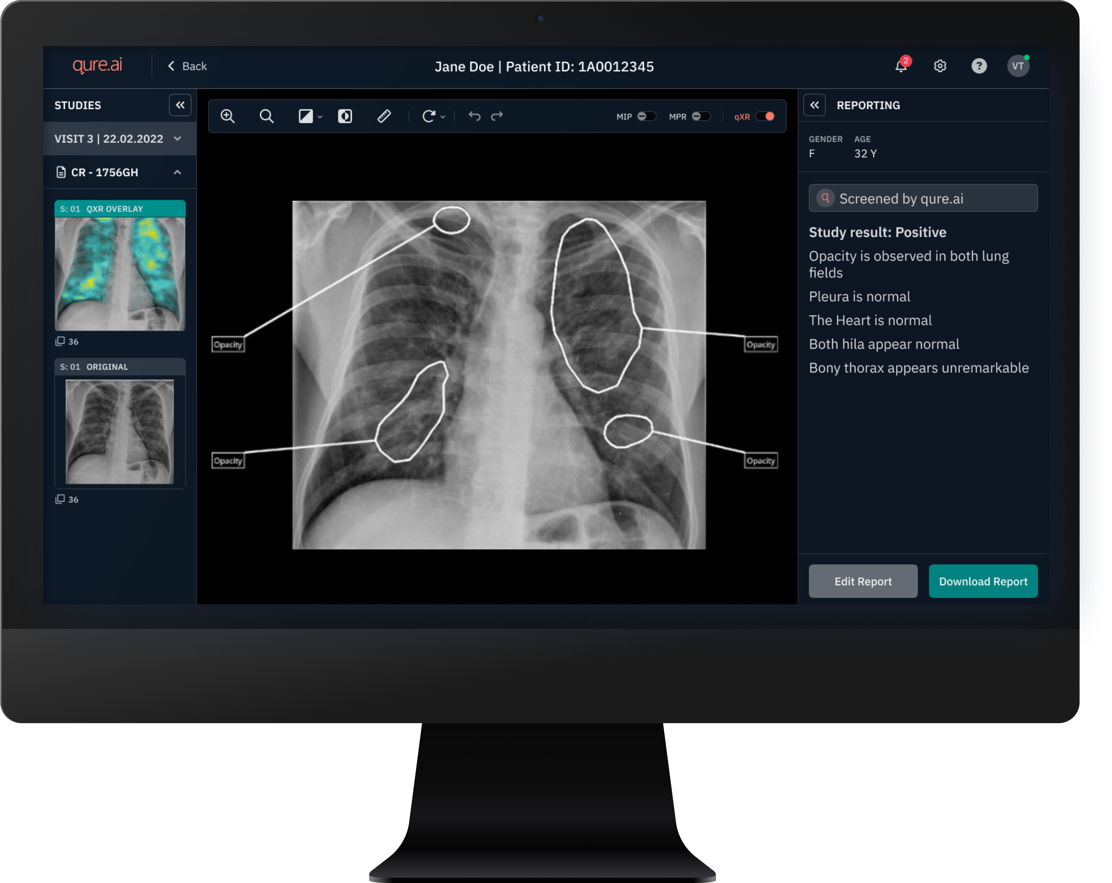 Image of computer screen showing the RADICAL AI-powered X-ray reporting system