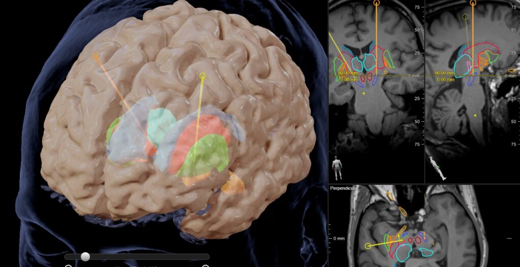 Digital image of deep brain stimulation
