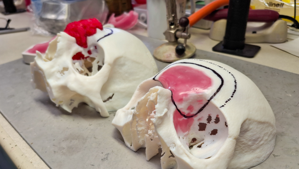 Two 3D printed models of the front of a skull, the one in the foreground with a pinks section circled in black ink, the one in the background with a model of a large red growth at the top of the nose
