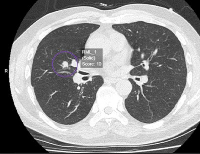 NHS Greater Glasgow and Clyde leads new study using AI to improve lung cancer diagnosis